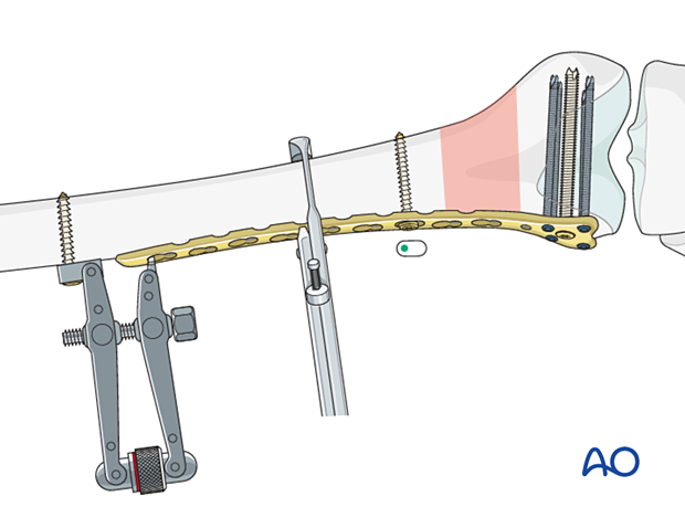 Eccentric screw insertion Eccentric screw insertion