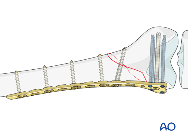 Insertion of proximal screws