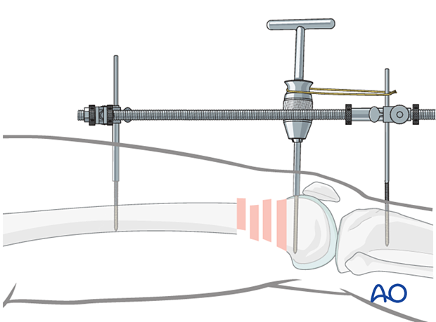 Usage of the external fixator/fimoral distractor