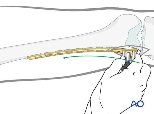 Condylar LCP insertion