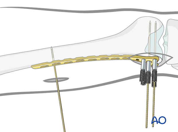 K-wire insertion in proximal fragment