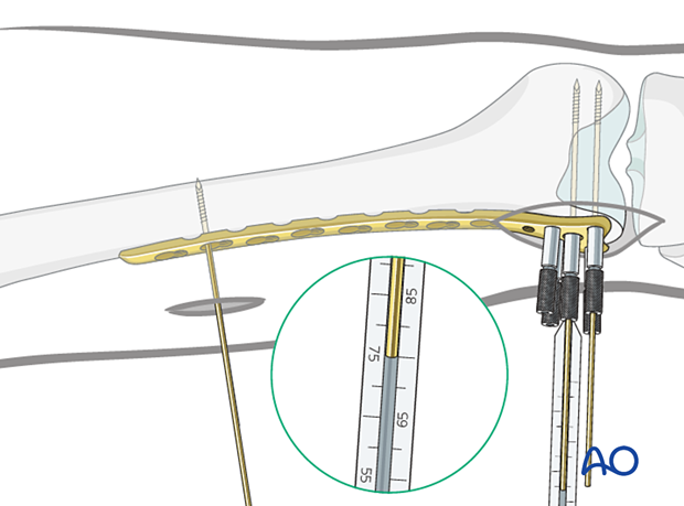 Screw lengths measurement