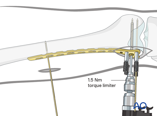 Distal screw insertion