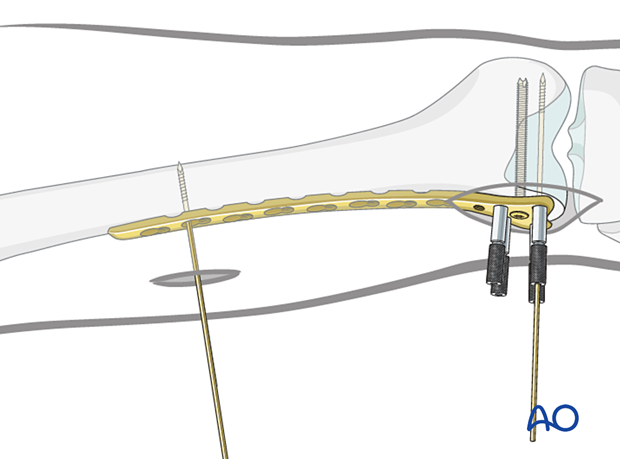 Insertion of first proximal scerw