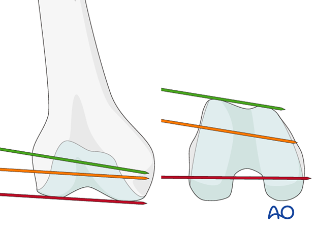 Verification of frontal alignent