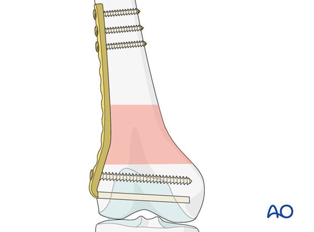 Final osteosynthesis