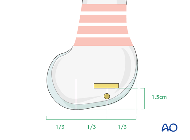 Correct blade insertion point