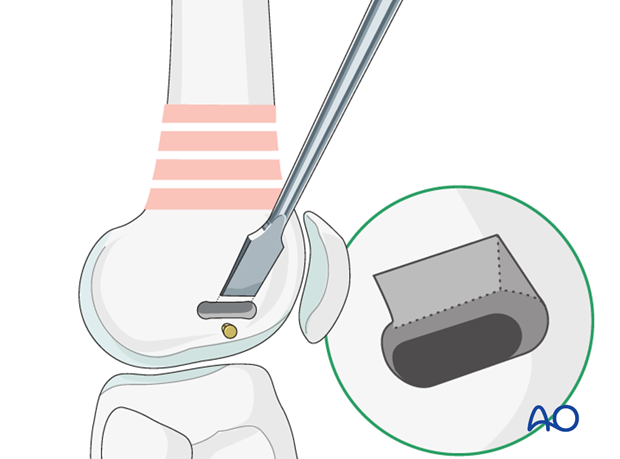 Rounding of the proximal slot shoulder