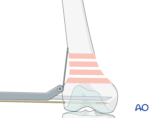 Insertion of the seating chisel