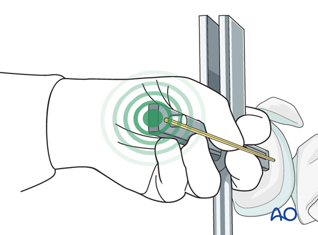 Seating chisel insertion