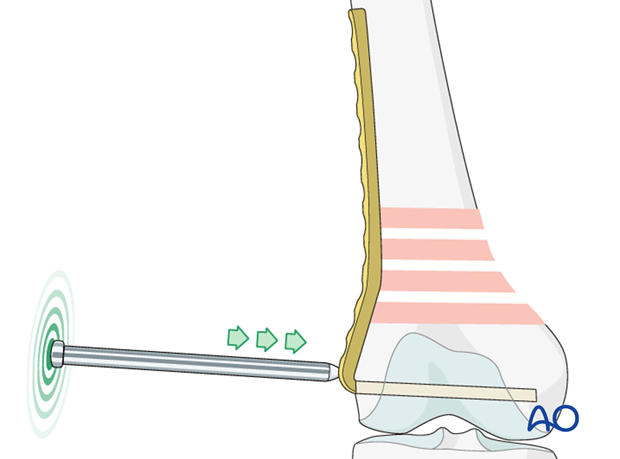 Impaction of plate to the bone