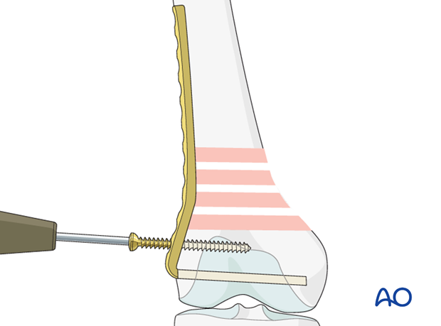 Insertion of first screw