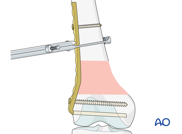 Final reduction of metaphyseal component