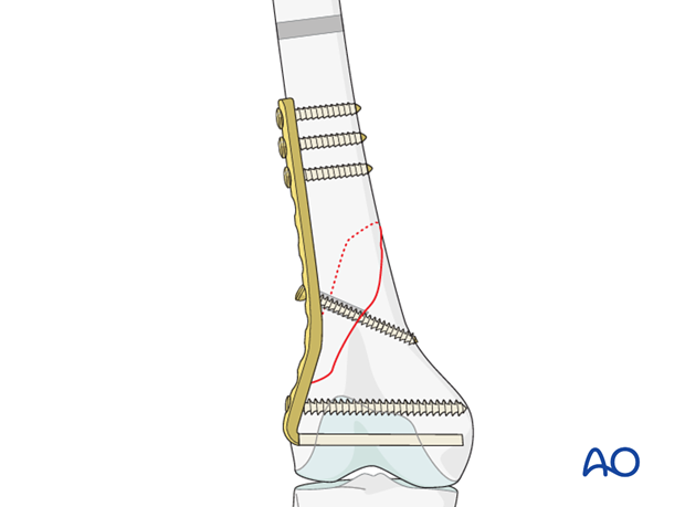 Insertion of lag screw