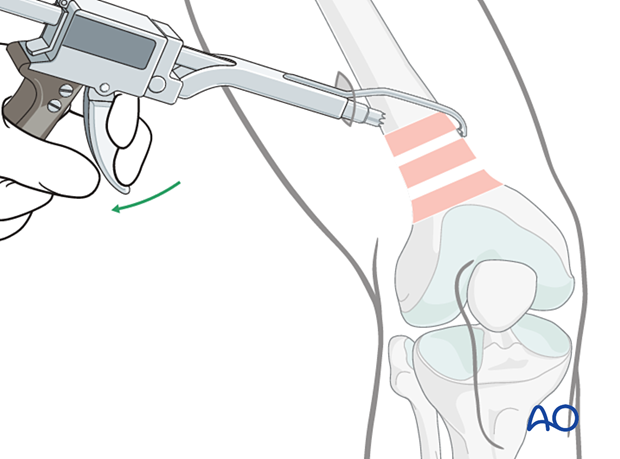 Reduction using collinear clamp