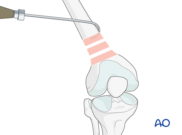 Reduction using bone hook