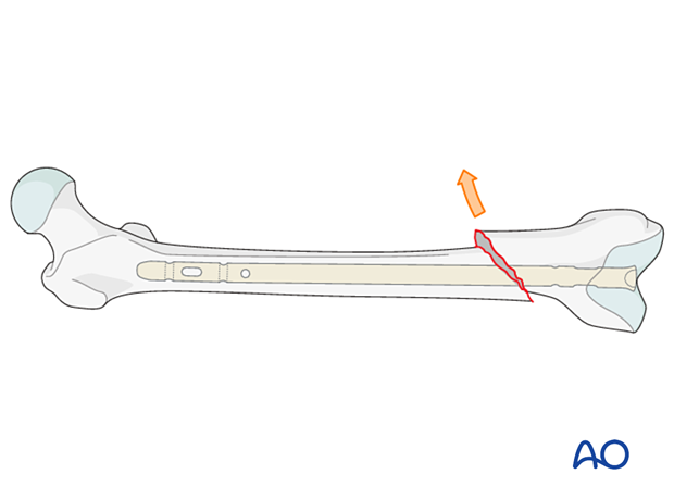 Poller screw concept