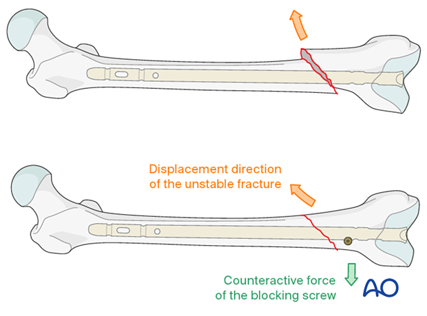 Poller screw location