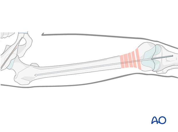 Insertion of guide wire