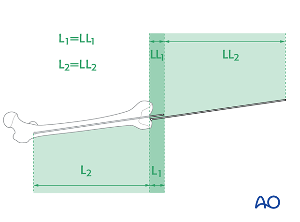 Determination of nail length using the guide wire