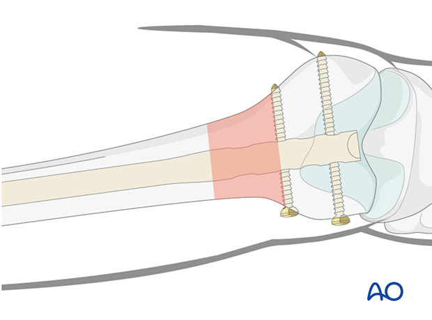 Distal locking