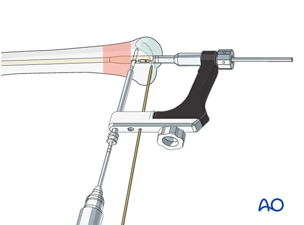 Attachment of distal aiming device