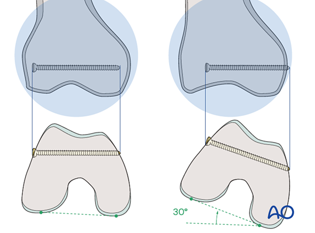 Tips for verification of locking screw placmenet