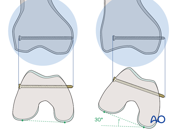 Example of inappropriate locking screw placement