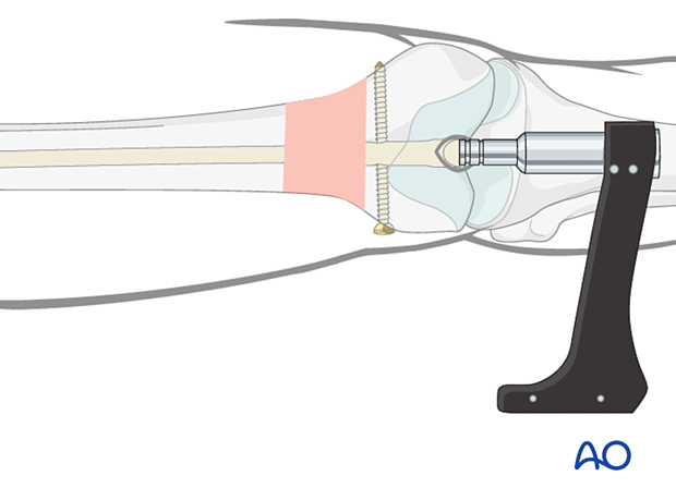 Attachment of spiral blade aiming arm