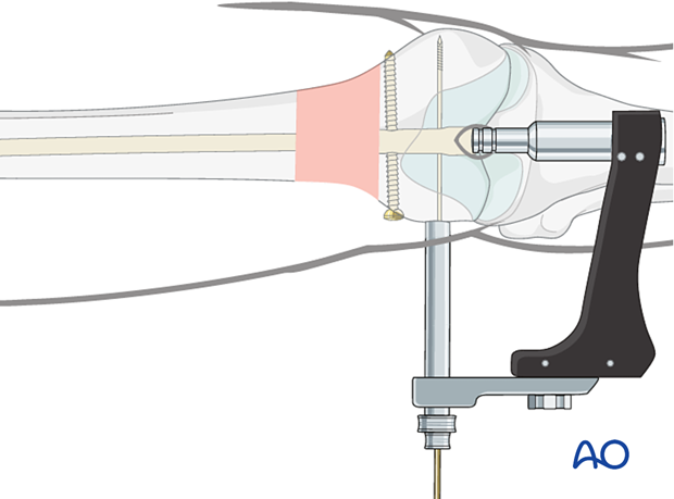 Measurement of spiral blade length