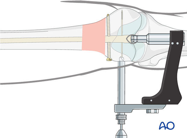 Opening of the lateral cortex