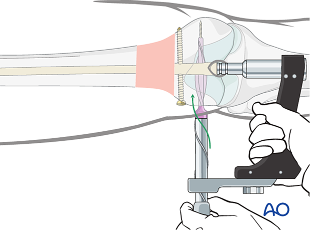 Insertion of the spiral blade plate