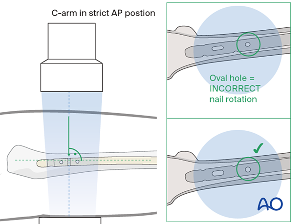 Drilling of screw hole for proximal locking screw