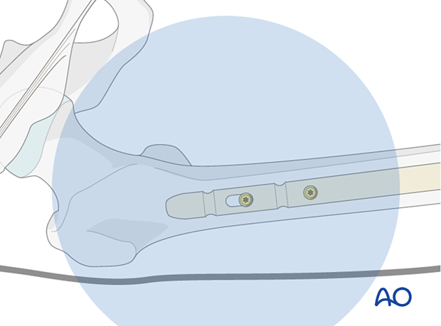 Insertion of second locking screw