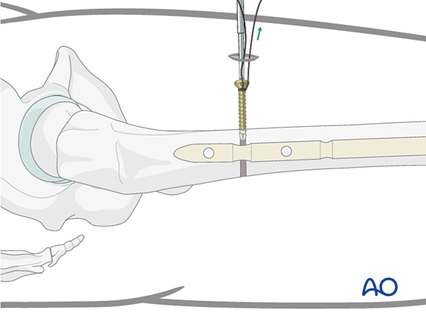 Use of lasso to pull out screws where the contact between the screw driver and locking screw is lost