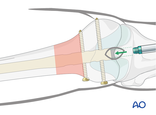 Insertion of the end cap with double screw distal locking