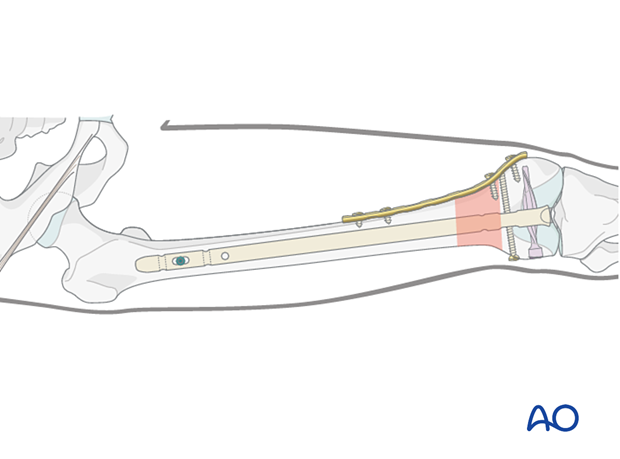 Medial plate application