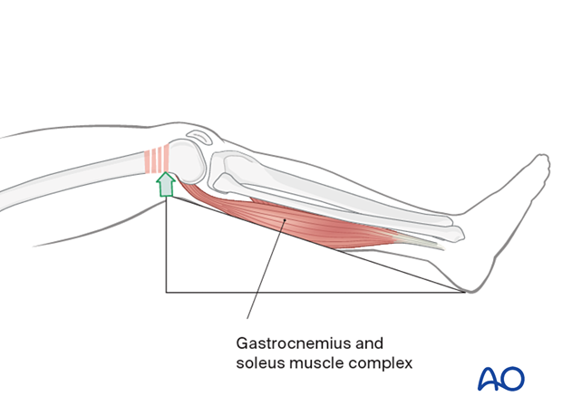 Use of a carbon triange to correct recurvatum deformity