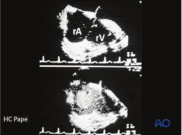 Image showing fat embolization