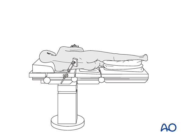 Supine positioning with abducted contralateral leg