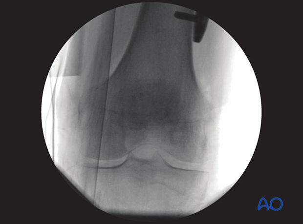 As reference, here the AP view of the same patient is given.