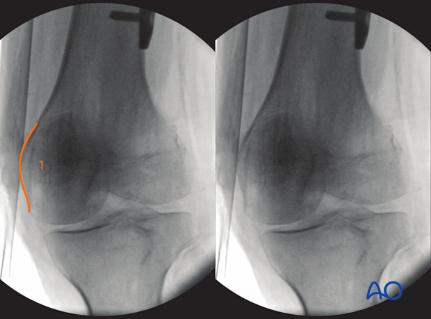 Anatomical landmarks and lines in the 25° External rollover view of the distal femur.