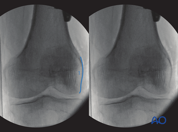 Anatomical landmarks and lines in the optimal 10° internal rollover view