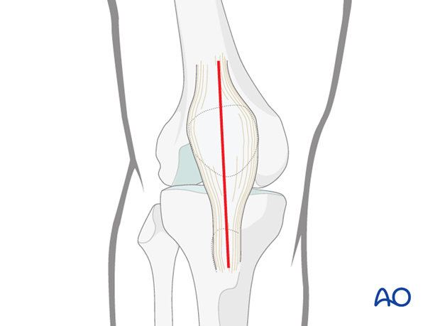 mid axial longitudinal approach