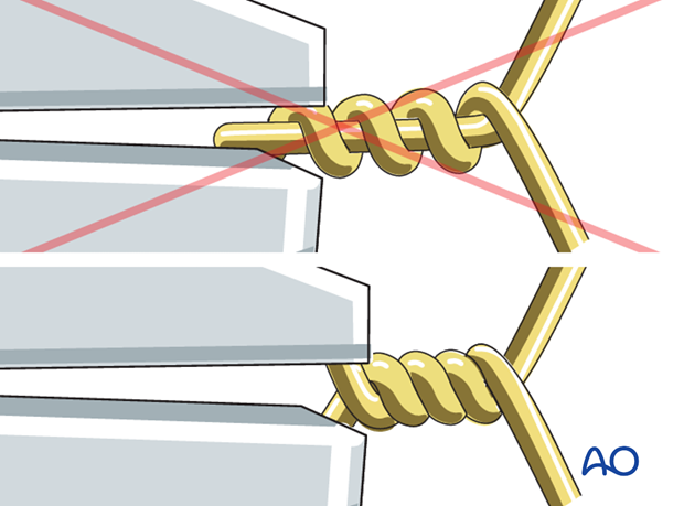 tension band wiring