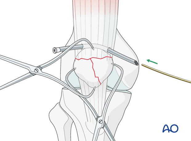 cerclage wire