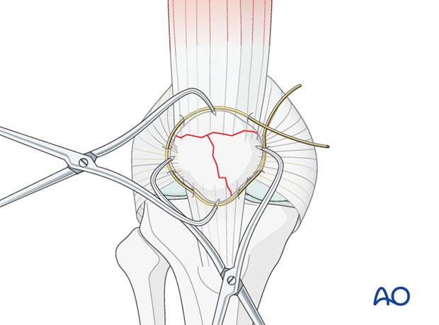 cerclage wire