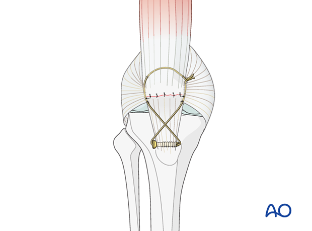 complete articular frontal coronal wedge fracture