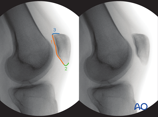 34 X550 Intraoperative imaging of the patella