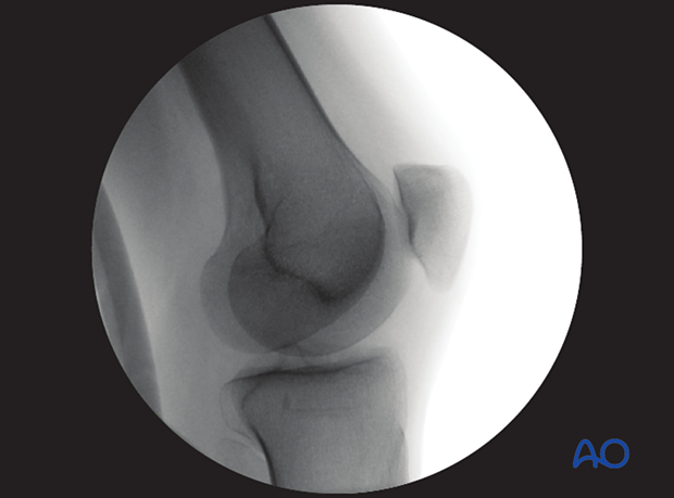 optimal accessory view of the lateral facet